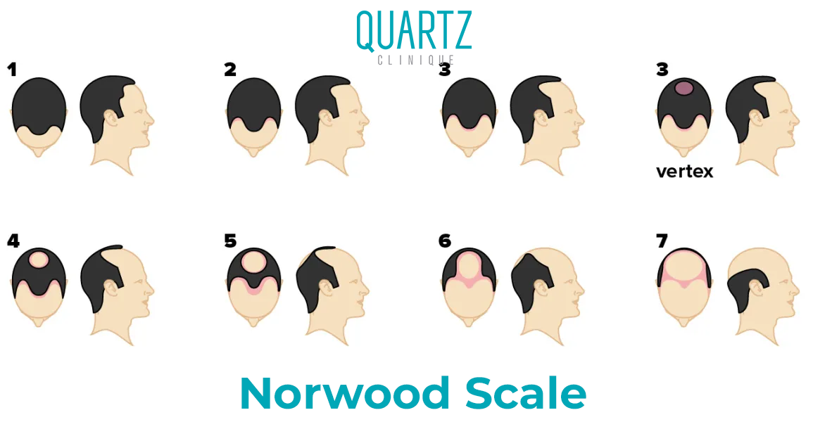 Norwood Scale 6 7 Hair Transplantation Quartz Hair