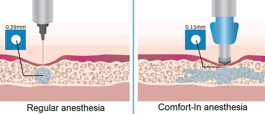 Anesthesia записи приватов. Нидлинг фильтрационной подушки. Нидлинг фильтрационной подушки глаза. Fetish Clinic Anesthesia-кастрация.