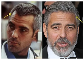 George-Clooney-hair-transplant.png.webp