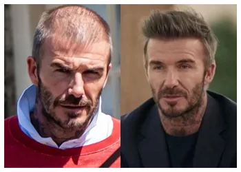 david beckam hair transplant