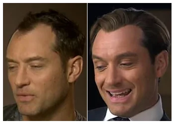 jude law hair transplant