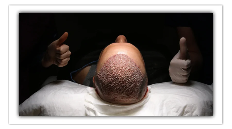 hair transplant